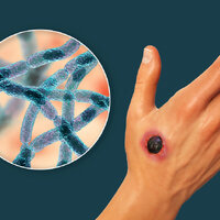 В Жамбылской области 4 человека заразились сибирской язвой